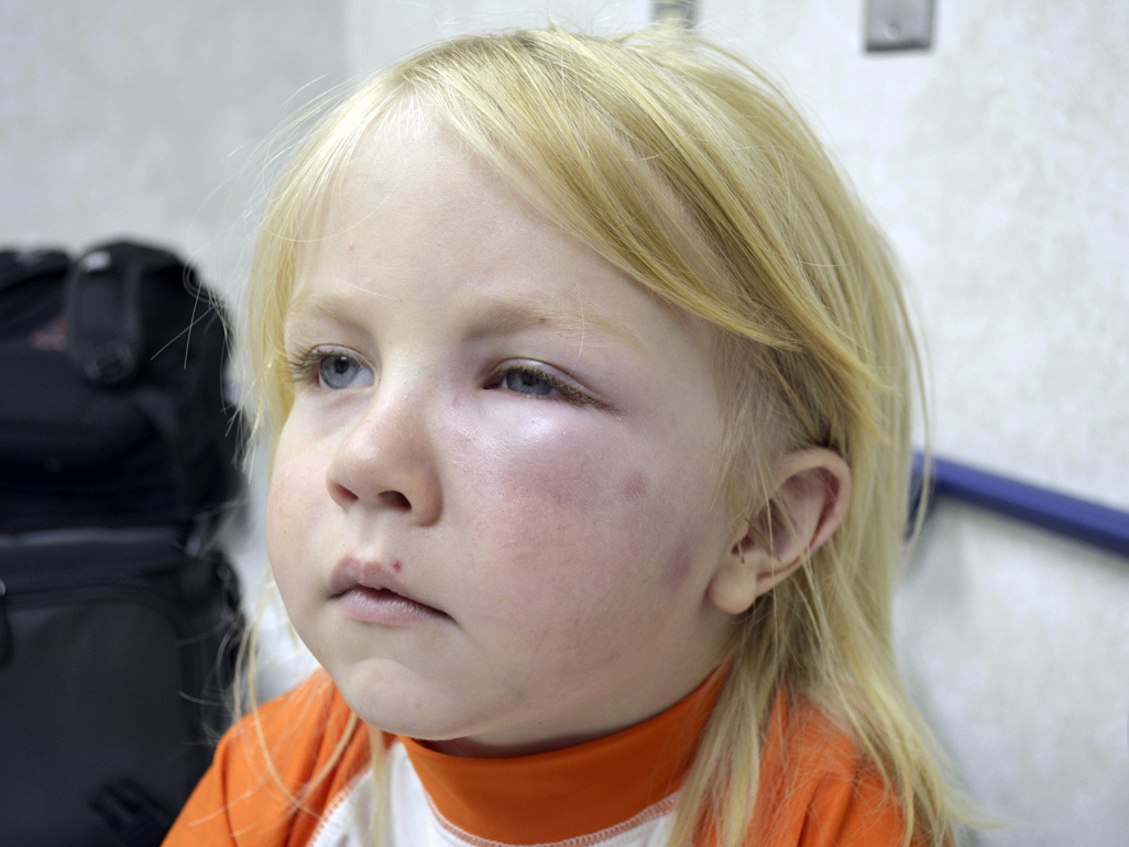 young child with swollen eyelids due to allergic reaction