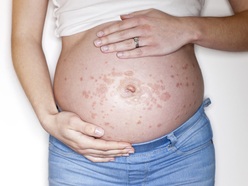 pregnant woman with PUPPP rash on belly