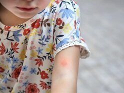 Child showing insect bite on arm